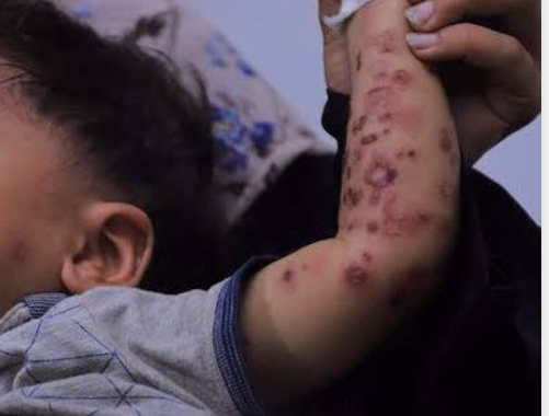 UNRWA Catat lebih dari 125 Ribu Kasus Infeksi Terkait Tikus dan Parasit di Gaza